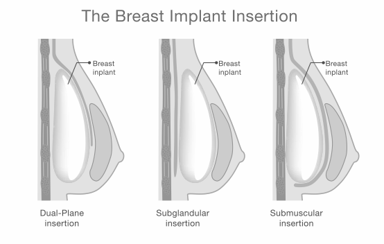 Breast-Implant-Insertion